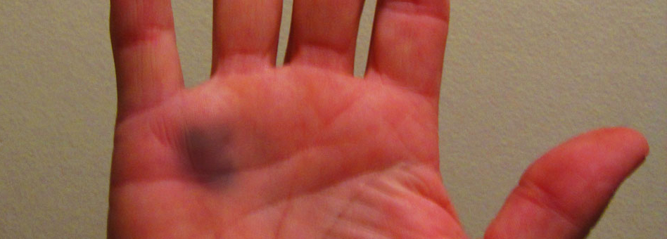 No more Bruised Hands